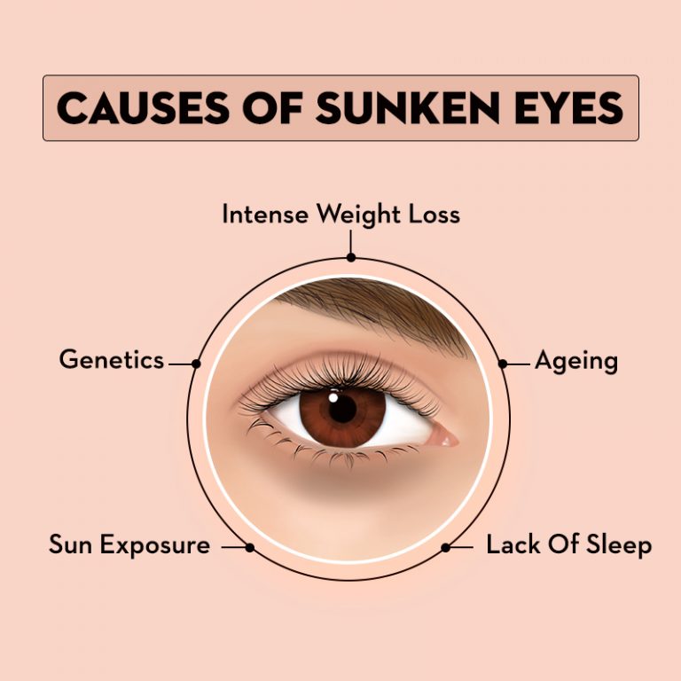 Dark Circles Under Eyes: Causes, Treatment, and Remedies